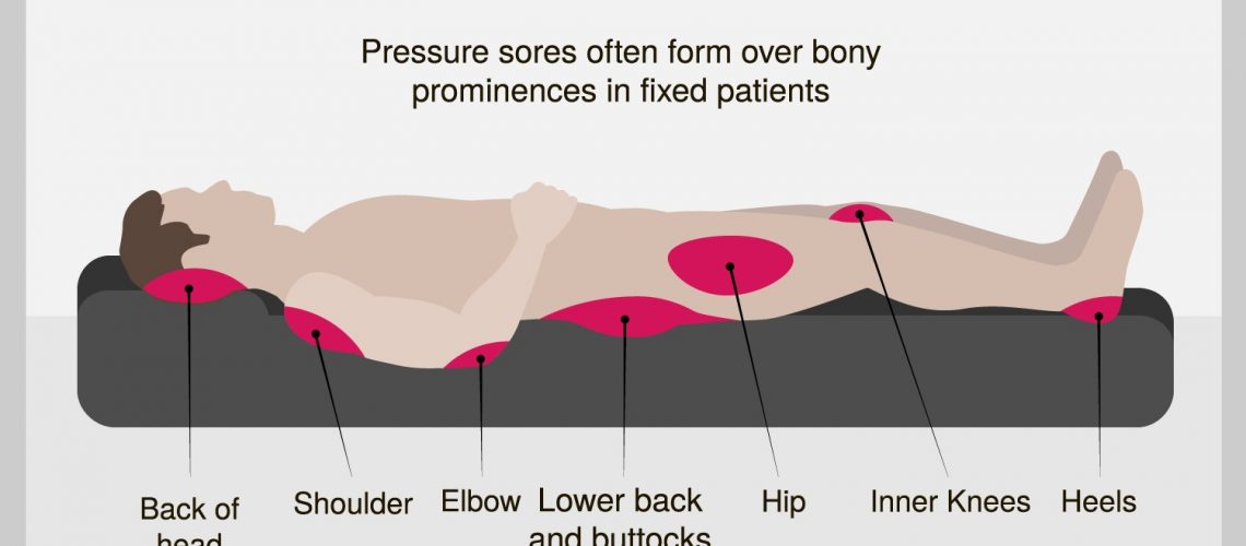 Pressure sores and ulcurs